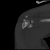 SPORK, NICO - 22.03.1976 - 02.08.2022 - CT obere Extremität - 17:59:07